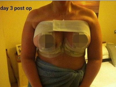 Mulher perde parte dos seios por necrose após colocar silicone 