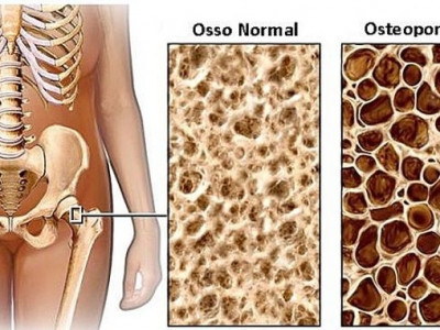 Campanha nacional alerta para risco de segunda fratura causada pela osteoporose