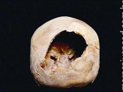  Arqueólogos encontram múmia que passou por cirurgia cerebral