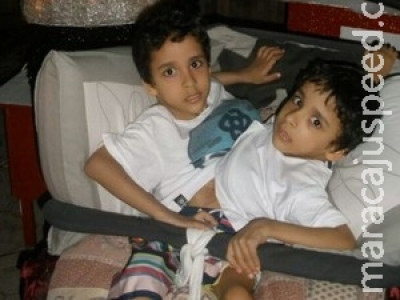 Gêmeos siameses de 5 anos são separados em hospital 