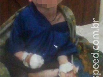 Menino albino de seis anos tem a mão decepada 