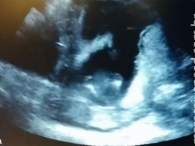 Vídeo de Bebê batendo palmas no ultrassom faz sucesso na web