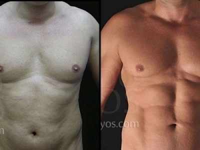 Tanquinho de bisturi: lipo cria barriga sarada e com gominhos