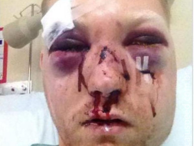  Jogador inglês cai de cara em barra de metal e é desfigurado