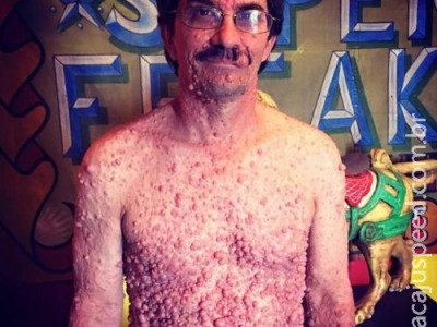 Homem coberto de caroços se aceita graças a show de horrores