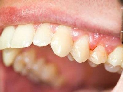  Manual da periodontite: a doença que causa perda dental