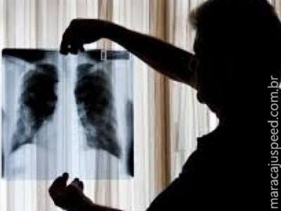 Novo tratamento contra câncer de pulmão pode dobrar sobrevida de pacientes, diz estudo