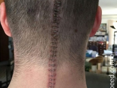 Homem reage com humor a cirurgia para retirar tumor no cérebro