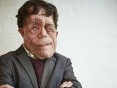  Britânico desfigurado conta cotidiano de olhares e agressões
