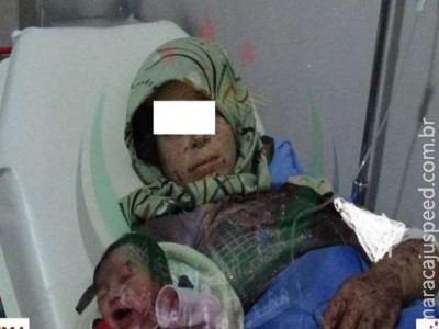 Síria: grávida ferida dá à luz bebê com marca de estilhaços