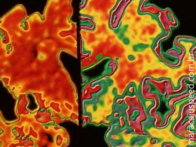 Cientistas levantam hipótese de transmissão do Alzheimer
