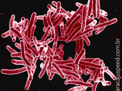Tuberculose rivaliza com Aids em número de mortes, alerta OMS
