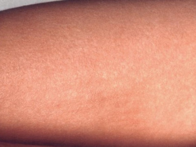 Manchas vermelhas pelo corpo: pode ser escarlatina?