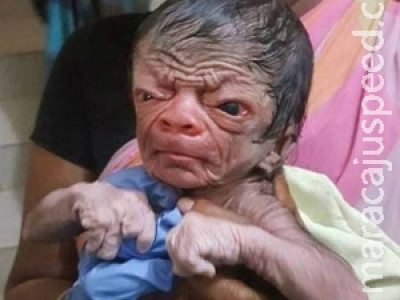 Menino " Benjamin Button " nasce em Bangladesh