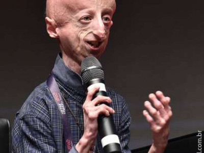  Itália opera coração de paciente com progeria pela 1ª vez