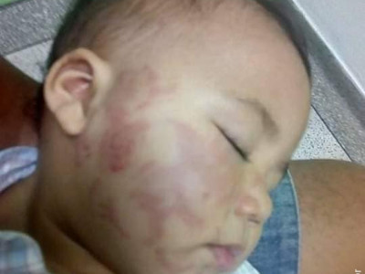 Mãe se desespera ao buscar bebê cheio de mordidas em creche