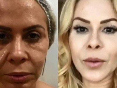 Joelma mostra antes e depois de harmonização facial e choca fãs