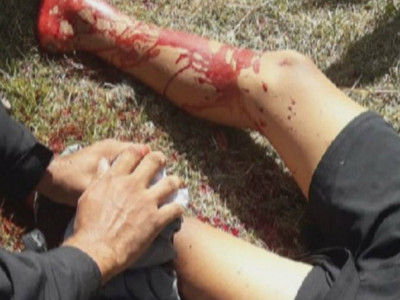 Jovem ferido com linha chilena terá perna amputada