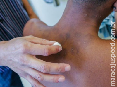 Hanseníase: conheça os sintomas e o tratamento para a doença