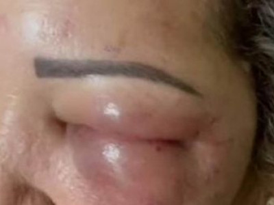 Mulher tem rosto desfigurado após procedimento estético na fronteira de MS