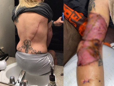 Furioso, pitbull avança contra dona e arranca pedaço do braço