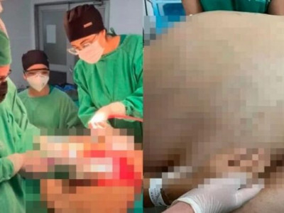 Mulher de apenas 1,5m retira tumor de 46kg no RJ