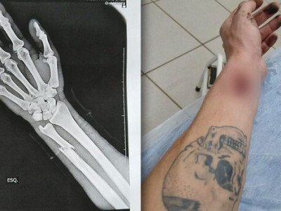 Sem realizar raio-x em UPA, paciente volta para casa com pontos em braço quebrado
