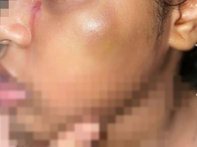 Pai tortura filha pequena com faca quente e pimenta no ouvido