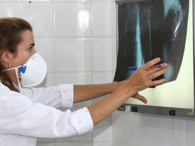 Governo cria comitê para reduzir casos de tuberculose até 2030