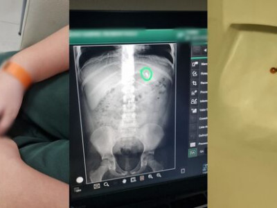 Criança de 8 anos engole bolinhas de imã em Campo Grande