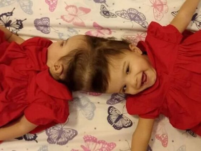 Gêmeas siamesas são separadas após cirurgia de 25 horas em SP