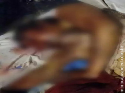 Mulher que teve o rosto desfigurado em ataque de ex perdeu olho 
