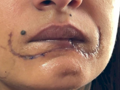 Polícia investiga caso de mulher que perdeu metade do lábio ao ser mordida pelo ex no interior de SP; suspeito fugiu