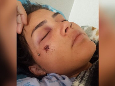 Grávida consegue cirurgia para retirar bala alojada no rosto