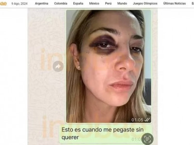 Ex-primeira-dama da Argentina mostra hematomas após agressões