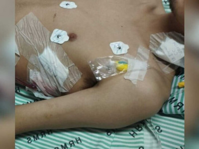 Jovem perde pulmão por fumar narguilé e 