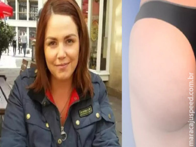 Inglesa morre após fazer ‘lifting de bumbum brasileiro’
