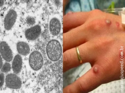 Mato Grosso do Sul tem 8 casos de Mpox confirmados em 2025