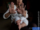 Hong Hong, o menino com 31 dedos