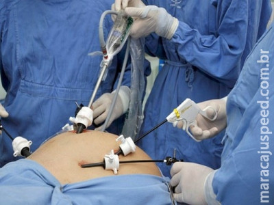 SUS passa a oferecer técnicas modernas para cirurgia bariátrica e tratar varizes SUS passa a oferecer técnicas modernas para cirurgia bariátrica e tratar varizes