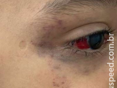 Padrasto tortura menino de 3 anos após criança fazer xixi na cama