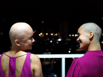 Jovem raspa cabelo para apoiar irmã gêmea diagnosticada com alopecia areata