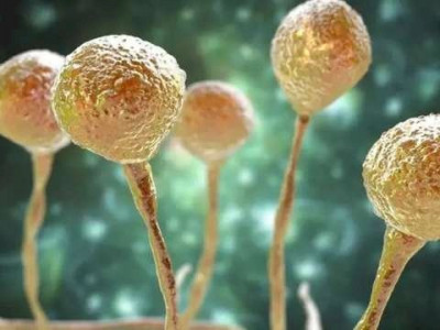 MS notifica novo caso suspeito de "fungo negro", em paciente de 31 anos