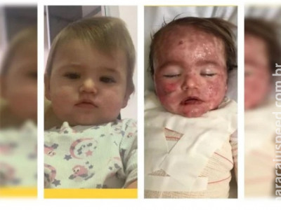 Bebê tem reação alérgica e acaba com rosto desfigurado