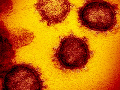 Estudo aponta sequelas neurológicas em pacientes leves de covid-19 Estudo aponta sequelas neurológicas em pacientes leves de covid-19