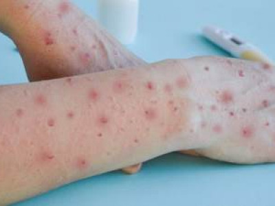 Porto Alegre investiga 1º caso suspeito de varíola dos macacos do país Porto Alegre investiga 1º caso suspeito de varíola dos macacos do país