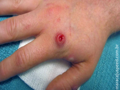 Cresce o número de mulheres infectadas pela varíola dos macacos em MS Cresce o número de mulheres infectadas pela varíola dos macacos em MS