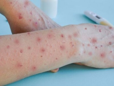 Jovem de 17 anos é diagnosticado com vírus Monkeypox em Sidrolândia Jovem de 17 anos é diagnosticado com vírus Monkeypox em Sidrolândia