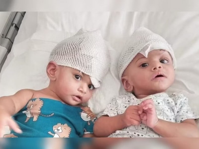 Siameses unidos pela cabeça são separados após 14 horas de cirurgia Siameses unidos pela cabeça são separados após 14 horas de cirurgia