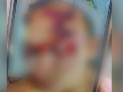 Jovem é espancado em confraternização e fica com rosto desfigurado em Sidrolândia Jovem é espancado em confraternização e fica com rosto desfigurado em Sidrolândia